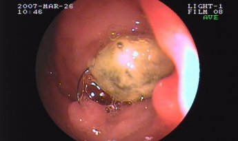 Tricobezoar duodenal