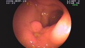 Duodenitis por CMV en paciente inmunodeprimido