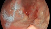 Gastritis eosinofílica